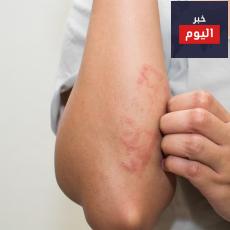 علاج الاكزيما