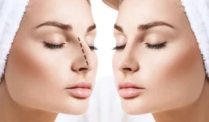 عملية تجميل الأنف
