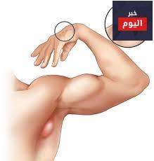 تورم الغدد الليمفاوية تحت الإبط