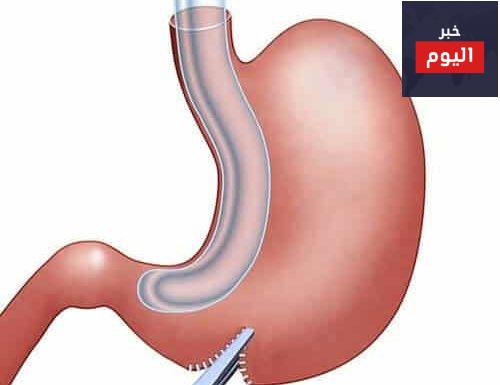 عملية تكميم المعدة: الفوائد والمخاطر