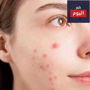 حب الشباب : أعراضه وأسبابه والعوامل التى تزيد من فرص الإصابه به وعلاجه