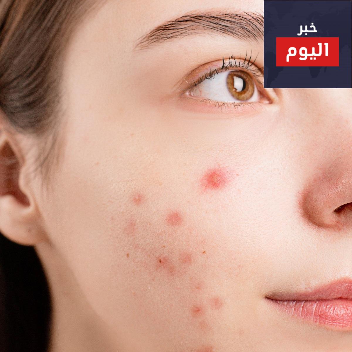 حب الشباب : أعراضه وأسبابه والعوامل التى تزيد من فرص الإصابه به وعلاجه