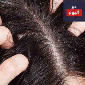 الحقيقة حول زيوت الشعر المضادة للقشرة