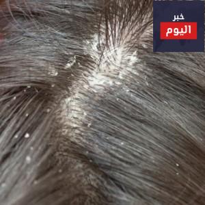 أفضل 5 الزيوت لقشرة الشعر للرجال ونساء