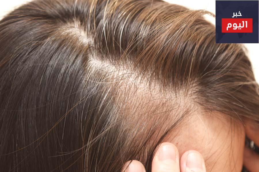 علاج تساقط الشعر مضمون 100