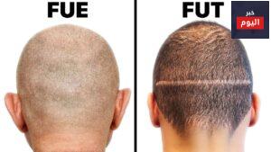 مقارنة بين طرق زراعة الشعر FUT وFUE.