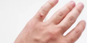 طريقة إزالة الثالول